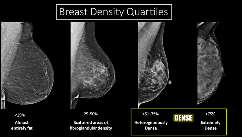 Breast density quartiles