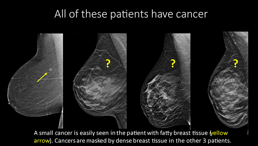 Cancer examples with varying breast density