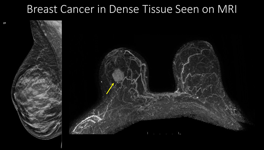 Breast cancer in dense tissue seen on MRI